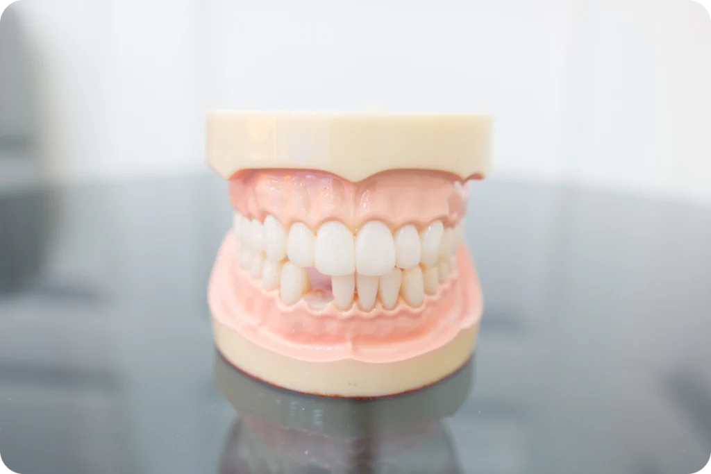 Modèle de mâchoire présentant plusieurs implants dentaires