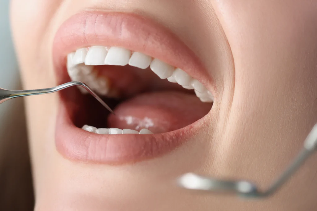 Soins des gencives