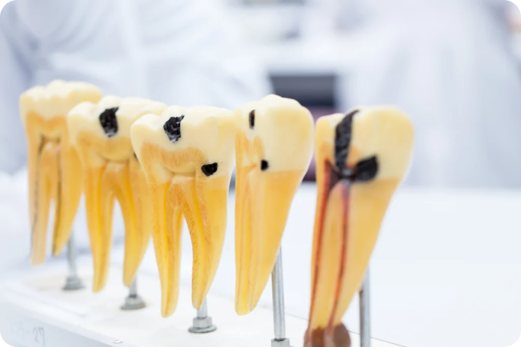 Schéma en coupe de plusieurs dents atteintes de caries profondes