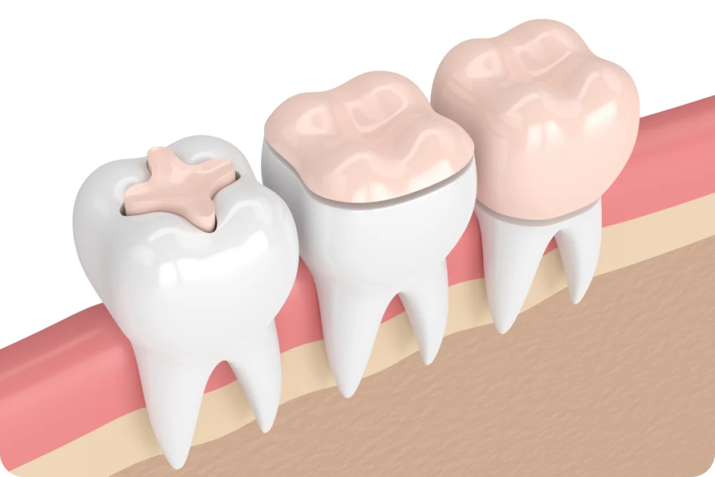 Illustration en coupe d'une dent avec un plombage dentaire