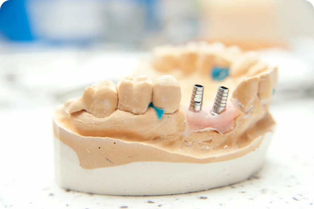 Modèle dentaire avec piliers d'implants après une greffe osseuse