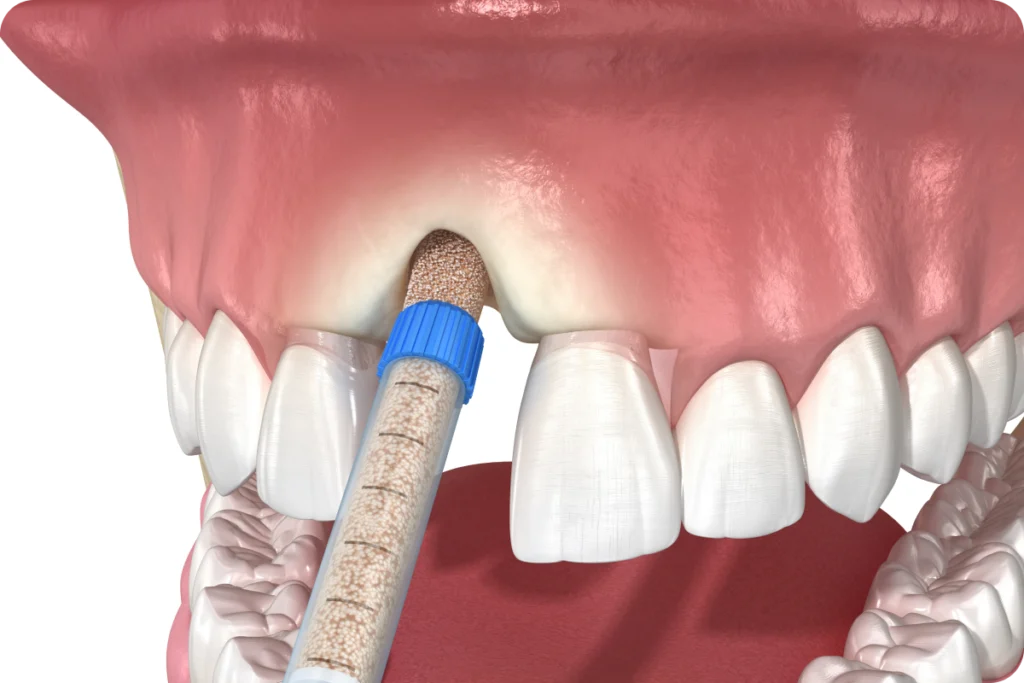 Illustration 3D de la pose d'un implant après greffe osseuse